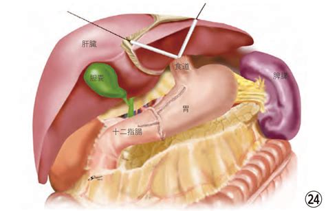 胃の腹腔鏡手術｜医療法人 山下病院