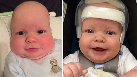 Infant Matthew Boler Doing Well After Undergoing To Fix