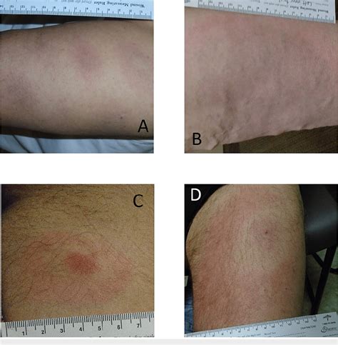 Figure 2 From The Spectrum Of Erythema Migrans In Early Lyme Disease