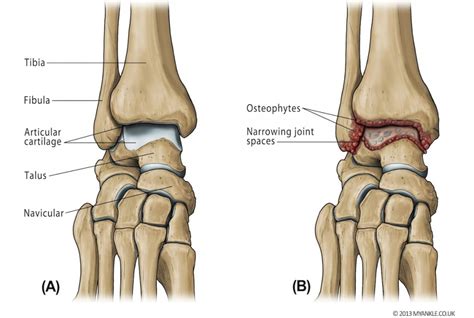 Types Of Arthritis That Affects The Knees Kneesafe Com