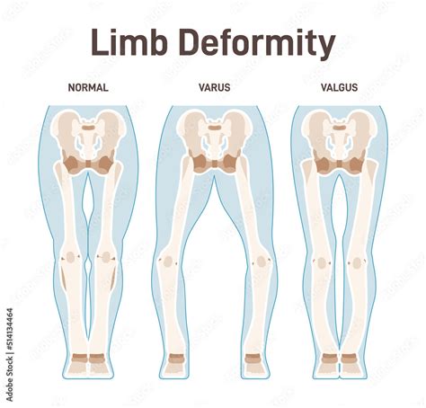 Vetor De Limb Anatomy Scheme Valgus And Varus Leg Deformities Diagram Of Normal Do Stock