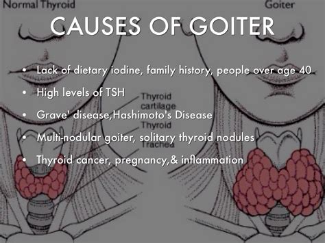 Homeopathic Treatment Of Goiter Without Operation