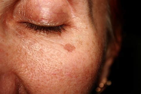 What Are Age Spots Western Maryland Dermatology