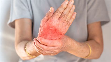 Asemanari Si Deosebiri Intre Afectarea Mainilor In Artroza Si In