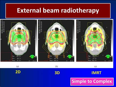 Ppt The External Beam Radiotherapy And Image Guided Radiotherapy 1