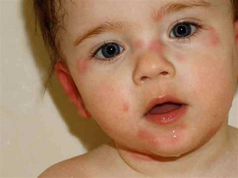 Introducing allergenic foods including eggs, tree nuts, fish, milk, peanut, soy, shellfish and wheat may cause a skin rash to appear. pictures of hives in children - pictures, photos
