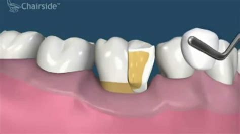 Dental Crown Lengthening Procedure Youtube