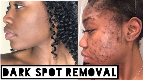 Are Acne Scars Considered Dark Spots