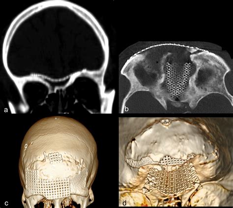 Reconstruction Of The Anterior Skull Base After Major Trauma Or