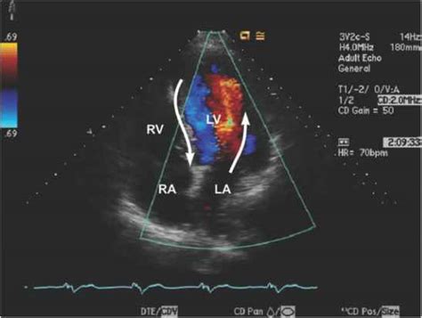 Color Doppler Heart Echocardiography Barnard Health Care