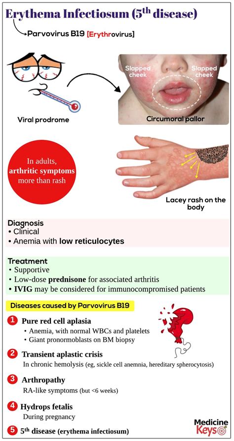 Erythema Infectiosum Fifth Disease Medicine Keys For Mrcps