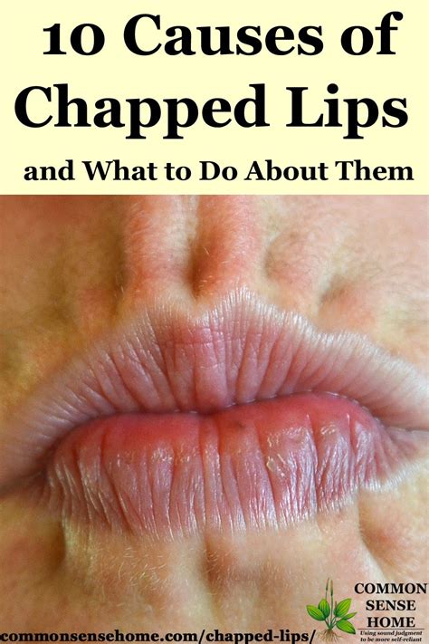 10 Causes Of Chapped Lips Plus How To Get Rid Of Chapped Lips