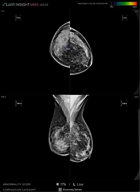 Cc And Mlo Mammograms Show A Lesion Presented With Architectural