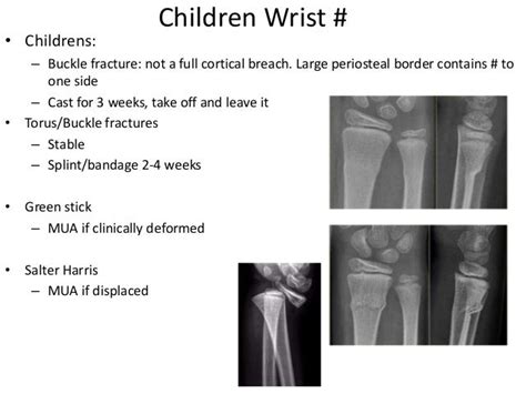 Common Fractures