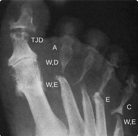 Psoriatic Arthritis Mutilans Clinical And Radiographic Criteria A
