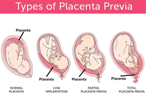 Placenta Previa Ultrasound