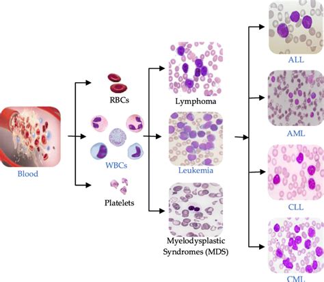 Blood Components And Main Types Of Leukemia Download Scientific Diagram