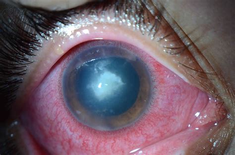 Orphan Drug Status Approval For Acanthamoeba Keratitis Received By