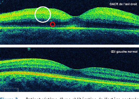 Spectral Domain Oct In Eyes With Retinal Artery Occlusion Semantic