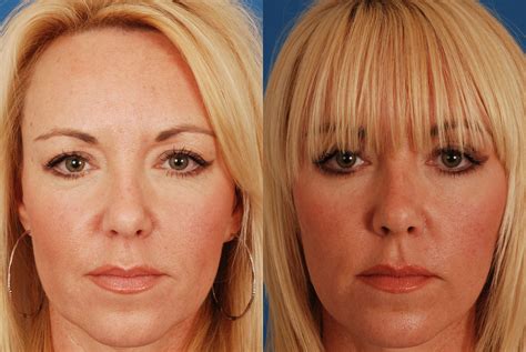 Rc Bassichis Filler Dallas Advanced Facial Plastic Surgery Center