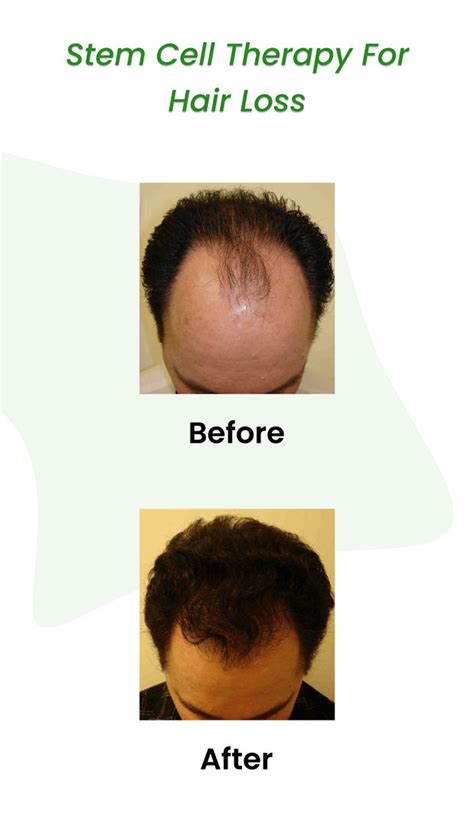 Stem Cell Hair Treatment 2023 All About Stem Cell Therapy For Hair Loss Clinicspots