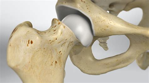 A Comprehensive Guide On Slipped Capital Femoral Epiphysis Atoallinks