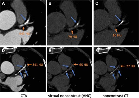 Calcium Scoring At Coronary Ct Angiography Using Deep Learning Radiology