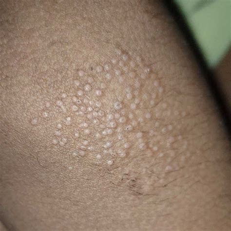 Cluster Of Bumps On Elbow