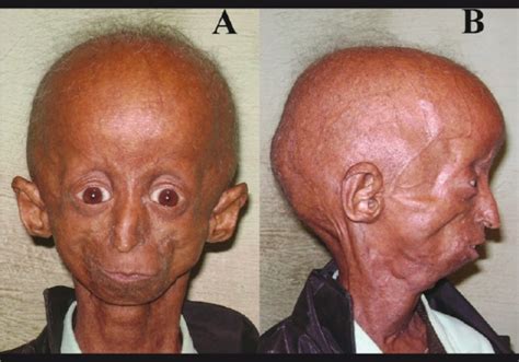 Progeria Life Expectancy