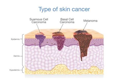 Skin Cancer Facts Signs And Symptoms And Treatment Summa Health