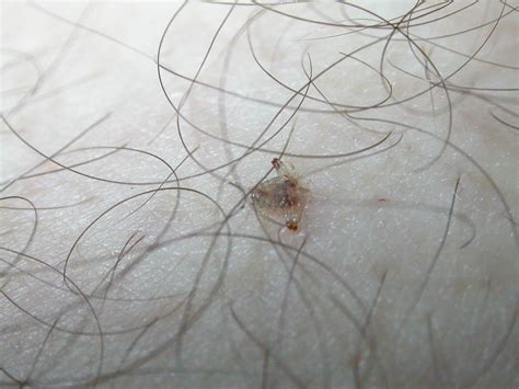 What Does Lice Look Like Photos Info On Head Body Pubic Lice