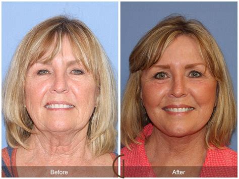 Having Performed Over Facelifts Throughout His Career This Facelift Before After Gallery