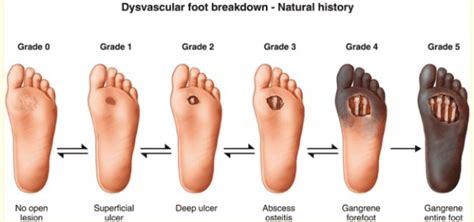 Diabetic Foot Sores Peachstate Advanced Cardiac And Endovascular Board