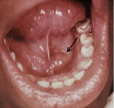 Hard Lump On Floor Of Mouth Under Tongue Home Alqu
