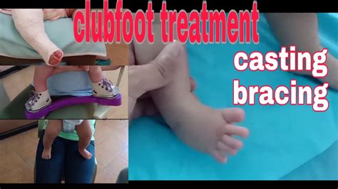 Cause of congenital club feet not clear. clubfoot treatment - YouTube
