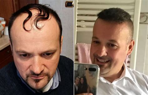 Before and after 1854 grafts fue hair transplant. Before and after hair transplant: Step-by-Step Situation ...