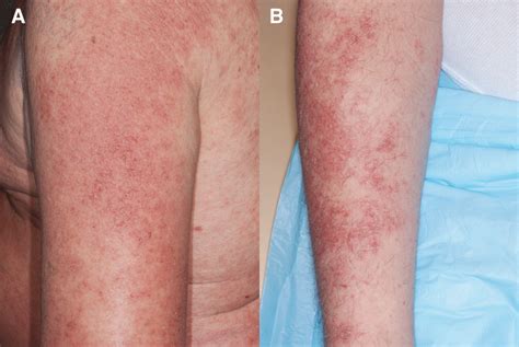 Clinical And Histopathologic Characteristics Of Rash In Cancer Patients
