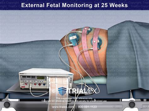 External Fetal Monitoring At 25 Weeks Trial Exhibits Inc