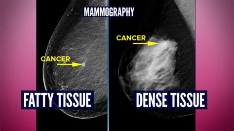 Do You Have Dense Breasts You May Need More Than A Mammogram