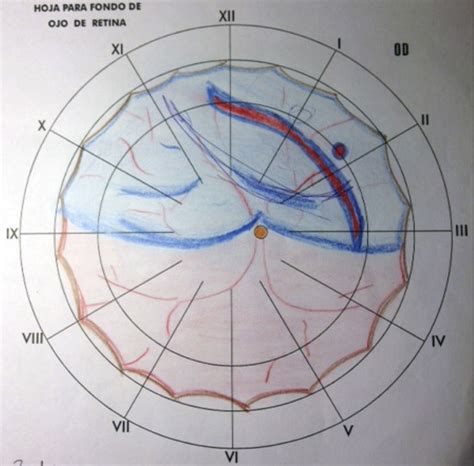 Pre Operative Schematic Drawing Showing The Topography Of The Retinal