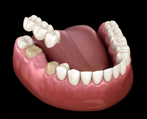 Dental Bridges By Top Orlando Dentist Dr Morales