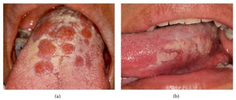 Oral Secondary Syphilis Papular Lesions On The Dorsum Open I