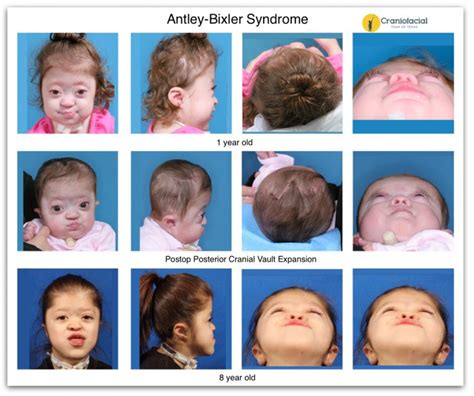 Craniofacial Syndromes Gallery Dell Childrens Craniofacial Team Of Texas