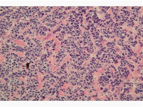 Treatment options for merkel cell carcinoma often depend on whether the cancer has spread beyond the skin. Dermpath Made Simple - Neoplastic: Merkel Cell Carcinoma