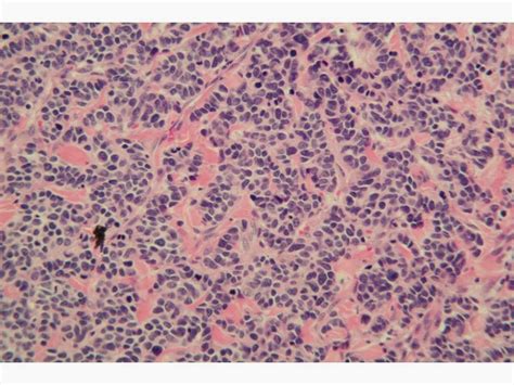 Incidence of merkel cell carcinoma in renal transplant recipients. Dermpath Made Simple - Neoplastic: Merkel Cell Carcinoma