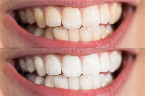 Tooth Whitening Bloxham Dental Practice