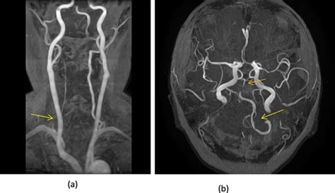 Impact Of Perioperative Management For Intracranial Arterial Stenosis