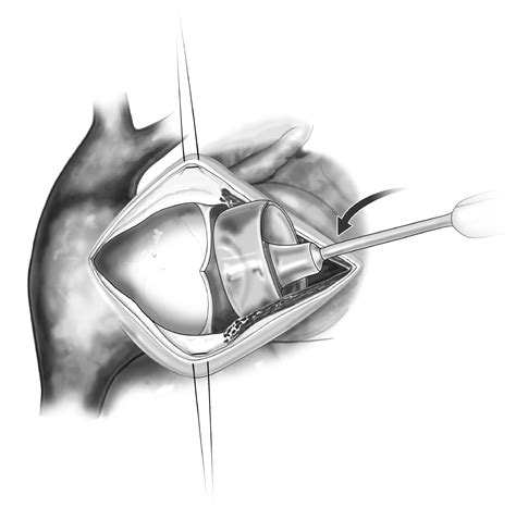 Bioprosthetic Pulmonary Valve Replacement Operative Techniques In