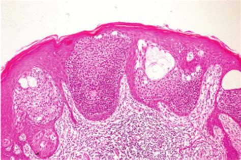 Histopathologic Examination Of The Flat Pigmented Plaque Disclosed Many