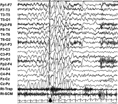 Epilepsy With Myoclonic Atonic Seizures Also Known As Doose Syndrome